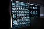 Científicos revelan que el Alzheimer puede predecirse por el olfato; crea una ventaja para la prevención