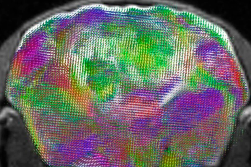 Stanford crea un modelo cerebral quimérico para investigar trastornos neurológicos